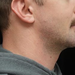 Chin Implants (Augmentation) Before & After Patient #24946