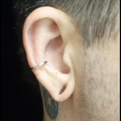 Earlobe Repair Before & After Patient #24951