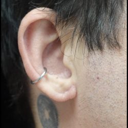 Earlobe Repair Before & After Patient #24951