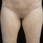 Labiaplasty Before & After Patient #24954