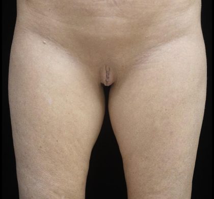 Labiaplasty Before & After Patient #24954