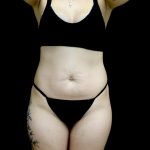 Tummy Tuck Before & After Patient #24938