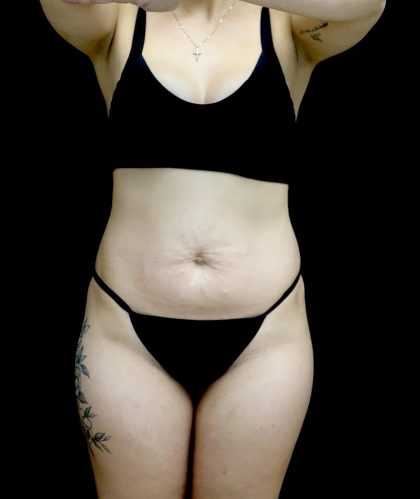 Tummy Tuck Before & After Patient #24938