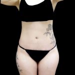 Tummy Tuck Before & After Patient #24938