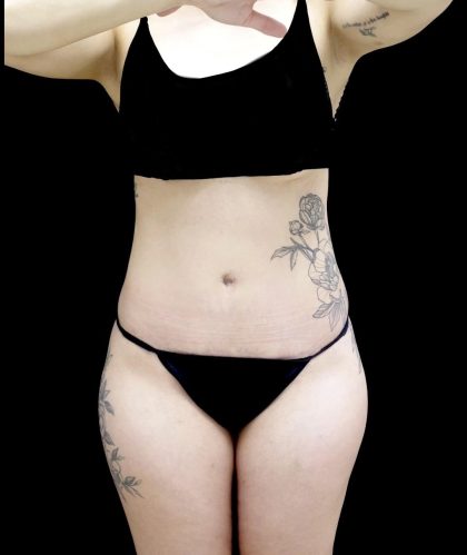 Tummy Tuck Before & After Patient #24938