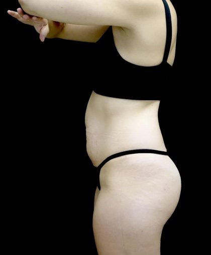 Tummy Tuck Before & After Patient #24938