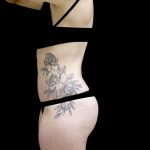 Tummy Tuck Before & After Patient #24938