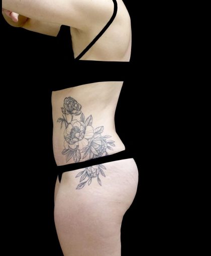 Tummy Tuck Before & After Patient #24938