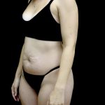 Tummy Tuck Before & After Patient #24938