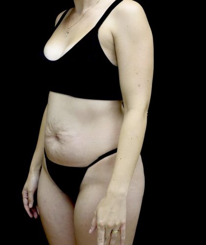 Tummy Tuck Before & After Patient #24938