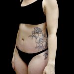 Tummy Tuck Before & After Patient #24938