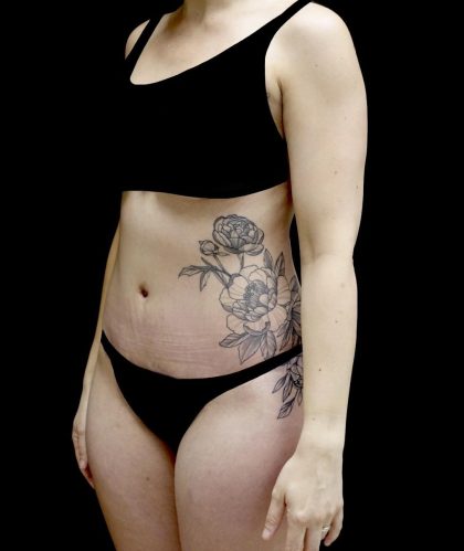 Tummy Tuck Before & After Patient #24938